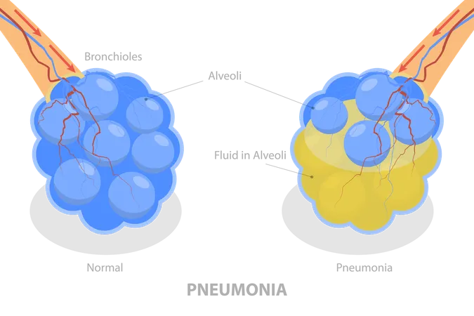 Pneumonia disease  Illustration