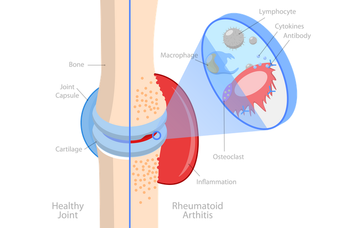 Polyarthrite rhumatoïde  Illustration