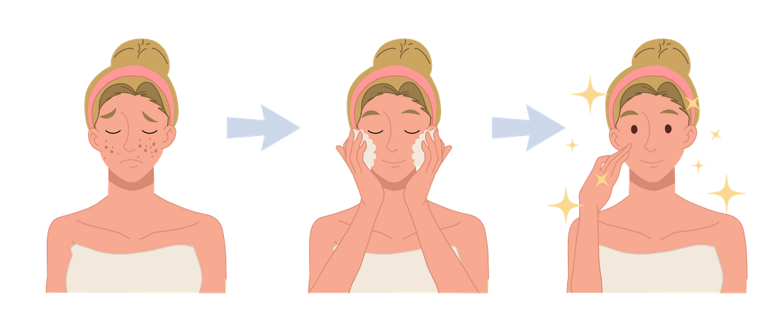 Procedimiento de tratamiento de cara clara.  Ilustración