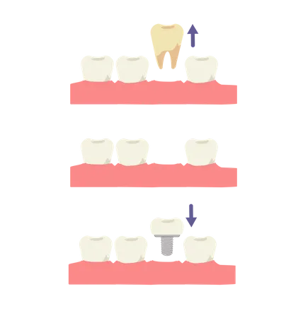 Concepto Medico Dental Implante Dental Proceso De Implante Dental Ilustracion Vectorial De Dibujos Animados Planos Ilustración
