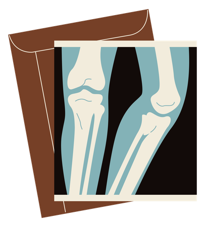 Radiografia de perna quebrada  Ilustração