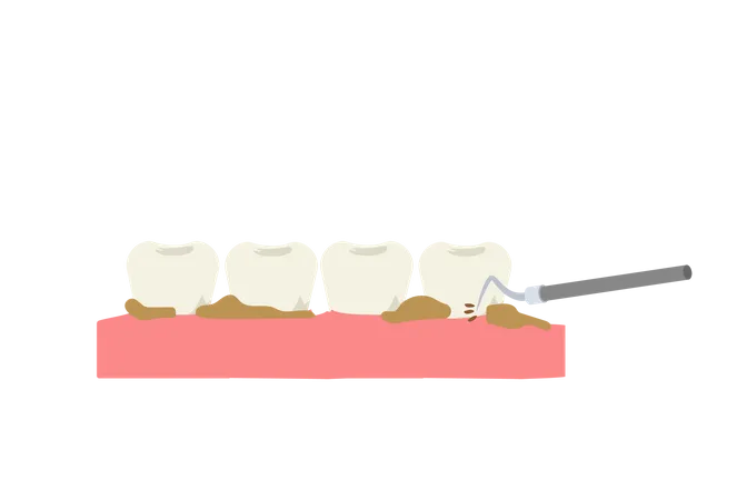 Raspagem de dentes usando ferramenta dentária  Illustration