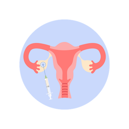 Removing oocyte from the ovary  Illustration