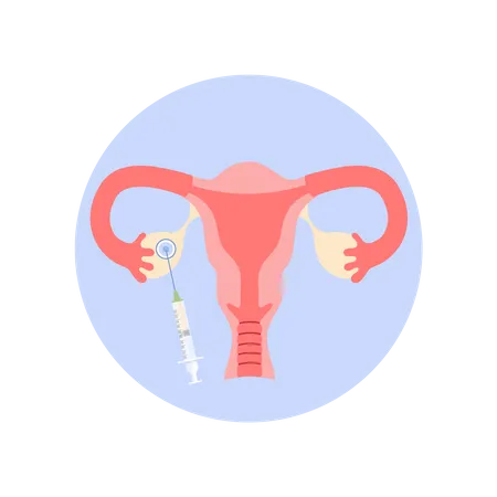 Removing oocyte from the ovary Illustration