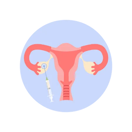 Removing oocyte from the ovary  Illustration