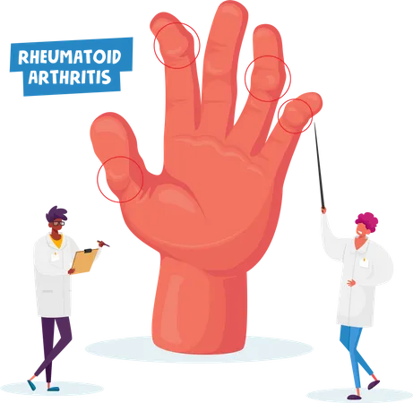 Rheumatoid Arthritis Doctor Arthrologist Pointing On Huge Hand With Joints Disease Nurse With Clip Board Colleagues Specialist Medical Concilium In Hospital Cartoon People Vector Illustration Illustration
