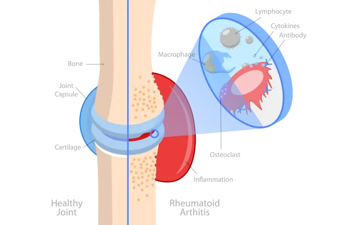3 D Isometric Flat Vector Conceptual Illustration Of Rheumatoid Arthritis Bones Pain Injury And Inflammation Illustration