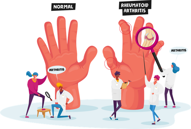 Rheumatoide Arthritis  Illustration