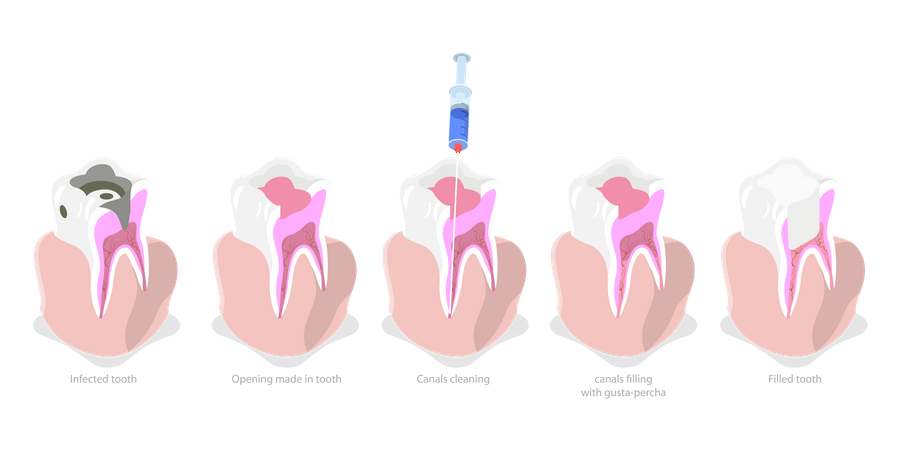 Root Canal Treatment  Illustration