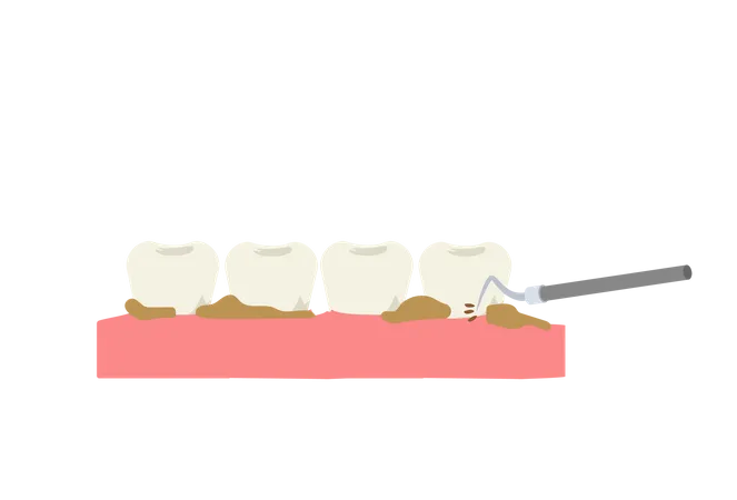 Scaling teeth using dental tool  일러스트레이션