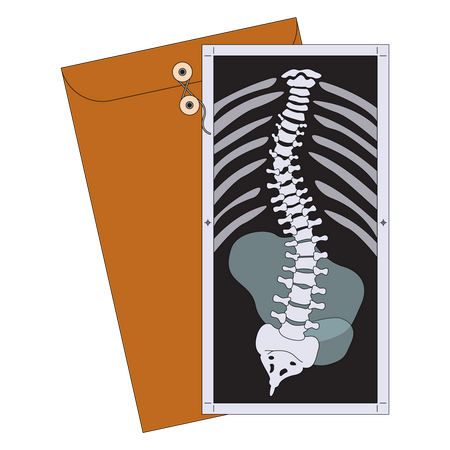 Scoliosis X-ray Illustration