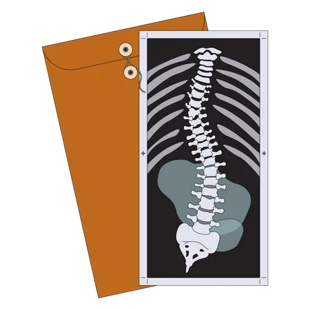 Scoliosis X-ray  Illustration
