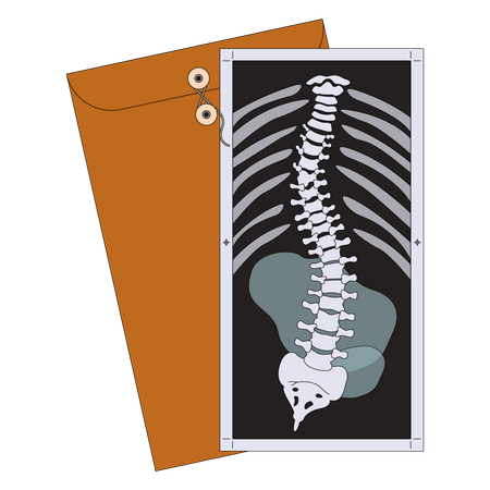 Scoliosis X-ray  Illustration