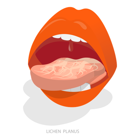 Sore Or White Tongue  Illustration