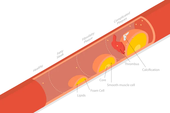 3 D Isometric Flat Vector Conceptual Illustration Of Stage Of Atherosclerosis Illustration