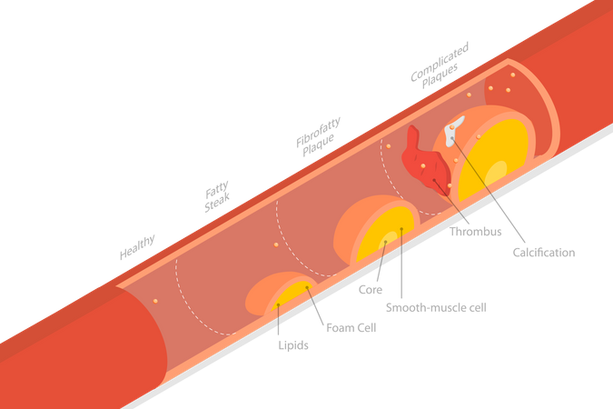 Stage Of Atherosclerosis  Illustration