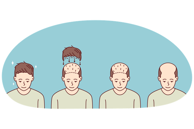 Stages of man hair transplant  Illustration