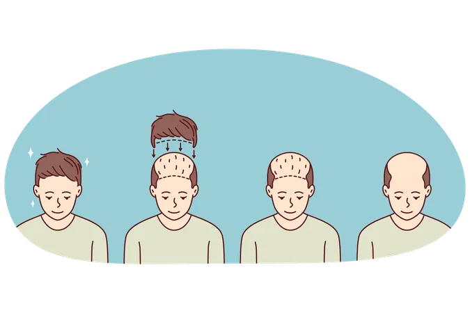 Stages of man hair transplant  Illustration