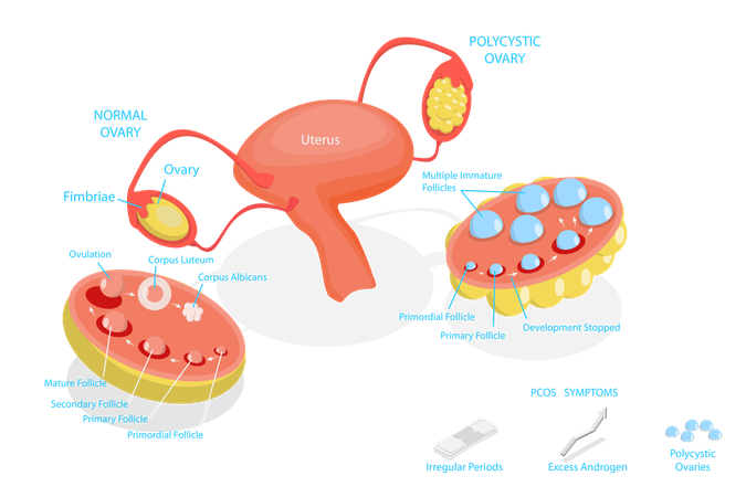 Syndrome des ovaires polykystiques  Illustration