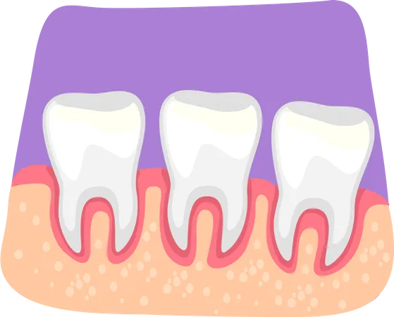Teeth Inflammation 2 D Vector Isolated Illustration Inflamed Gums Flat Sticker On Cartoon Background Bacterial Infection Gingivitis Risk Colourful Scene For Mobile Website Presentation イラスト