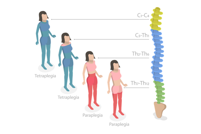 Tetraplegia And Paraplegia  Illustration