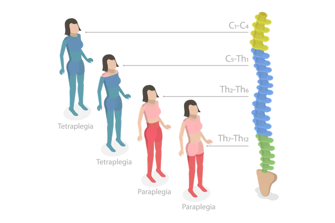 Tetraplegia And Paraplegia  Illustration