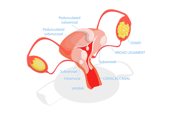 Tipos de fibromas uterinos  Ilustración