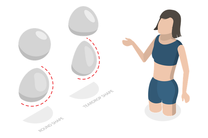 Tipos de implantes mamarios  Ilustración