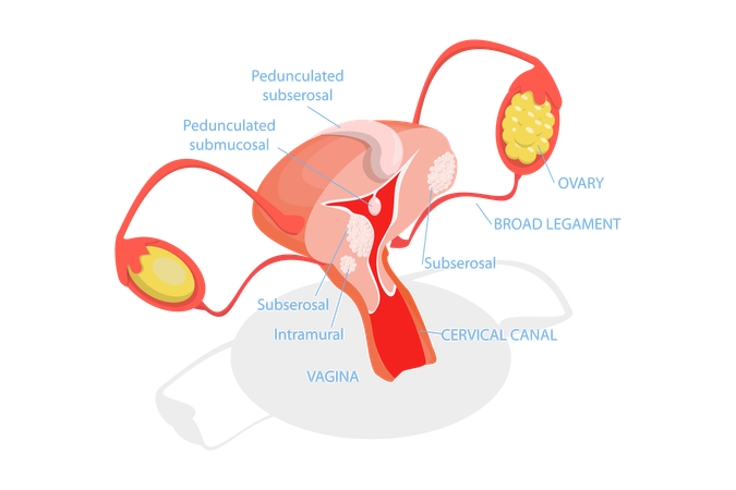 Tipos de miomas uterinos  Ilustração