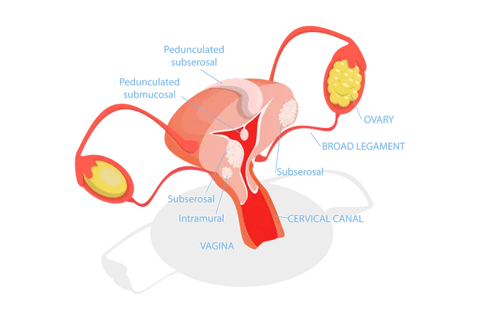 Tipos de miomas uterinos  Ilustração