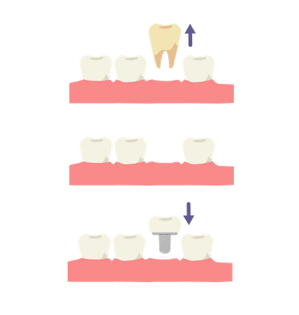 Tool implant process  Illustration