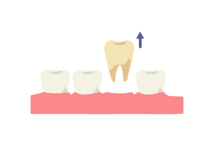 Dental Medical Concept Tooth Extraction Flat Cartoon Vector Illustration Illustration