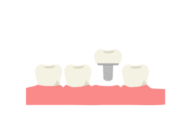 Tooth implant  Illustration