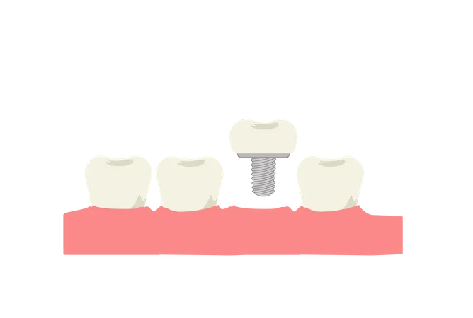 Dental Medical Concept Tooth Implant Dental Implant Flat Cartoon Vector Illustration Illustration