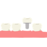 tooth implant images