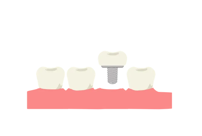 Tooth implant  Illustration