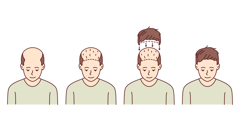 Transplante de cabelo  Ilustração