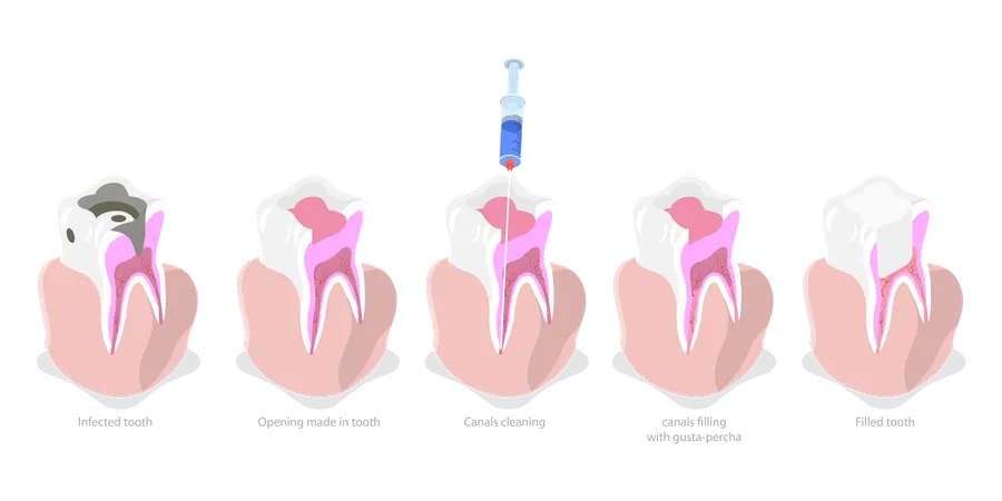 Ilustracion Conceptual De Vector Plano Isometrico 3 D De Caries Dental Cuadro De Tratamiento De Conducto Radicular Ilustración
