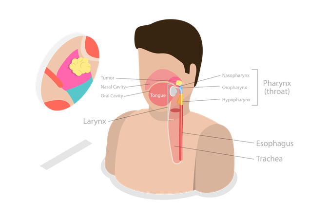 Tumor de carcinoma nasofaríngeo  Ilustração