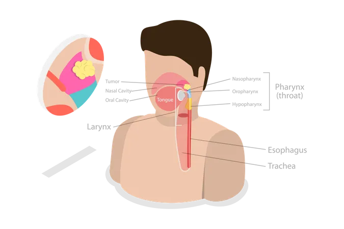 Tumor de carcinoma nasofaríngeo  Ilustración