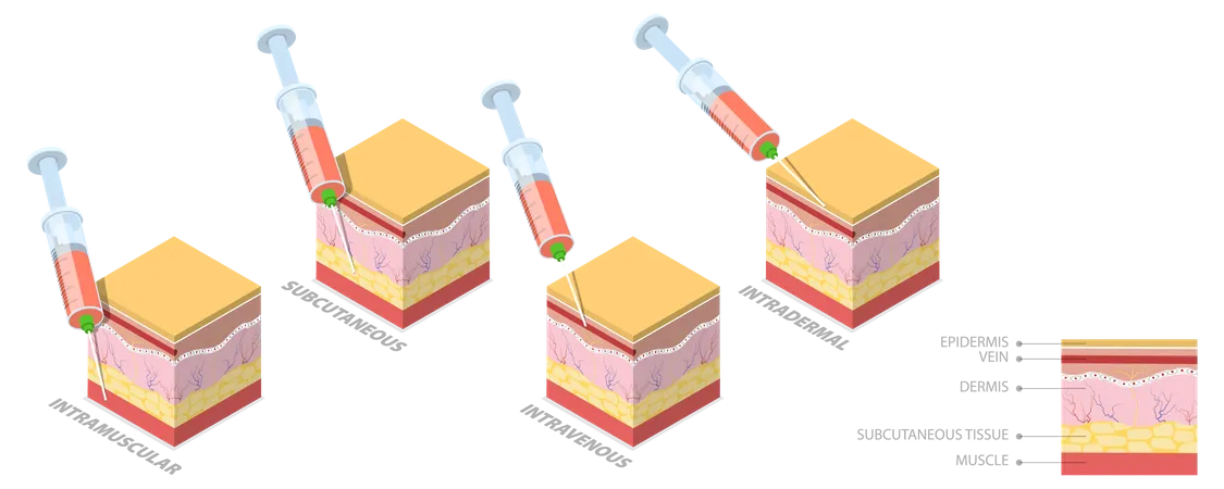 Types d'injections  Illustration