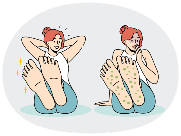 Une femme présentant une éruption cutanée sur les pieds souffre d'allergies et d'une infection fongique qui provoque de fortes démangeaisons  Illustration