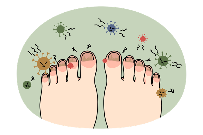 Ungesunder Fuß mit Nagelinfektion oder Virus  Illustration