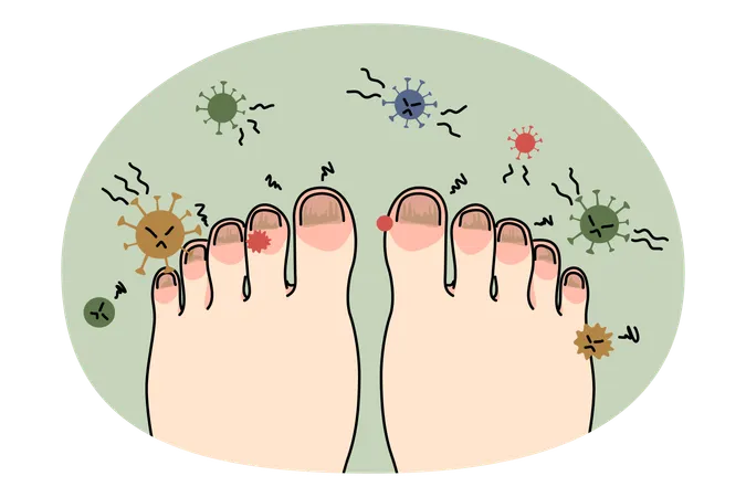 Ungesunder Fuß mit Nagelinfektion oder Virus  Illustration