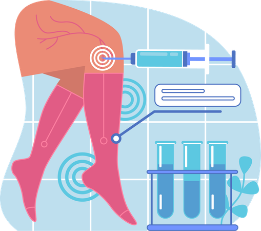 Varicose veins treatment  Illustration