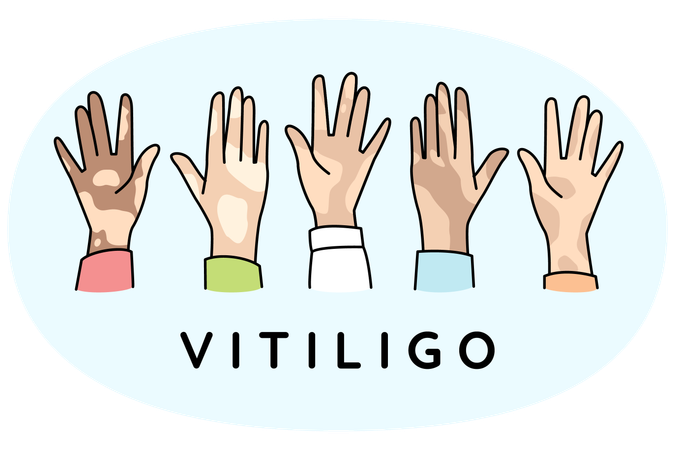 Verschiedene Hände von Menschen leiden an Vitiligo-Krankheit  Illustration