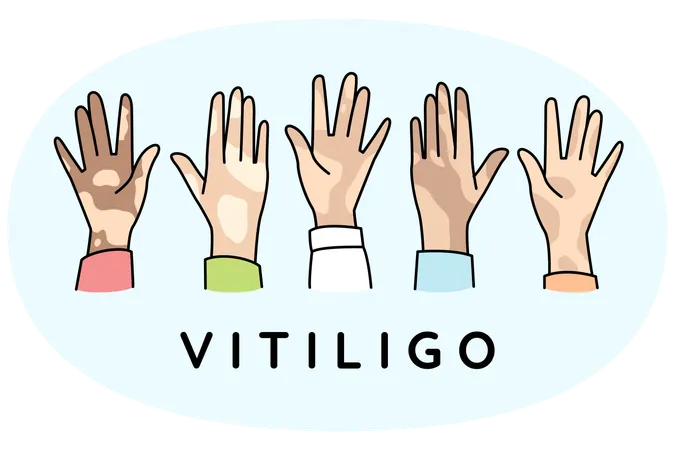 Verschiedene Hände von Menschen leiden an Vitiligo-Krankheit  Illustration
