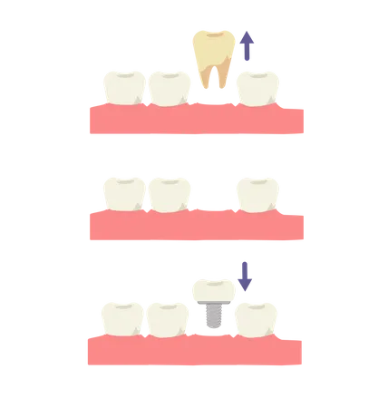 Werkzeugimplantationsprozess  Illustration