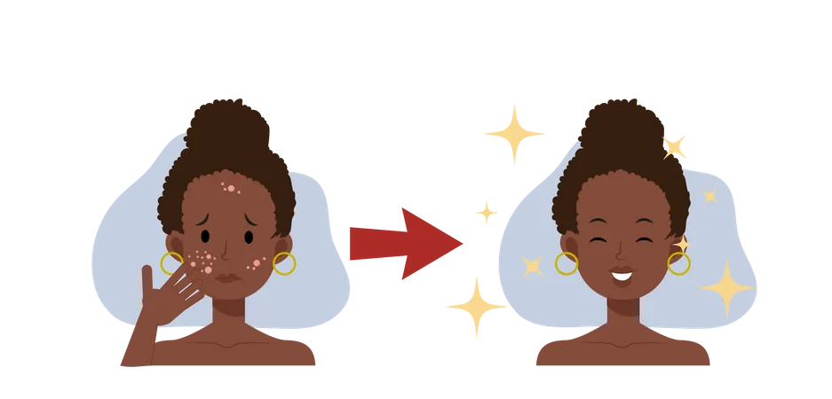 Treat Acne Skin Problem Pimple African American Woman Face Beautyful Flat Vector 2 D Cartoon Character Illustration Before After Illustration