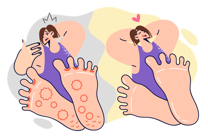 Woman with foot fungus before and after using medicinal ointment  Illustration